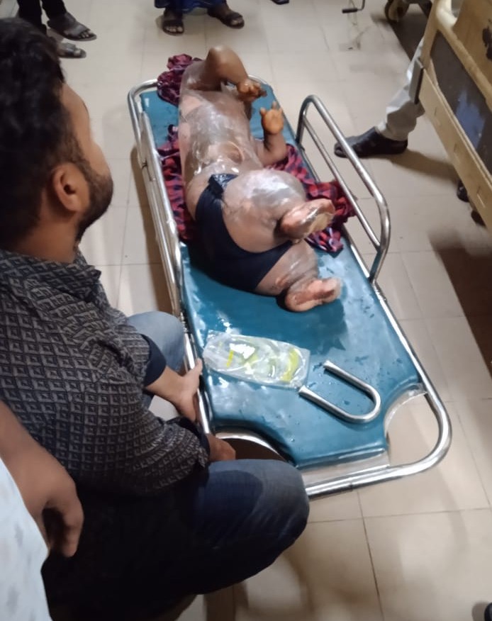 নোয়াখালীতে অটোরিকশার সিলিন্ডার বিস্ফোরণে পাঁচ শিশুসহ আহত ৬